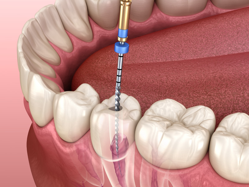 Root Canal Therapy