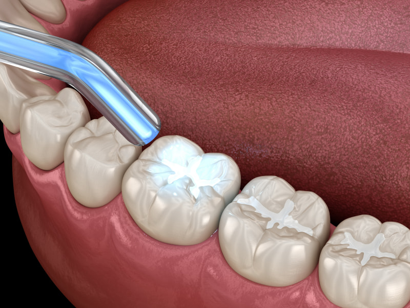 Protect your teeth with dental sealants