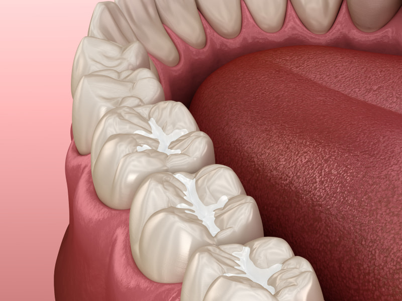 Tooth-Colored Fillings