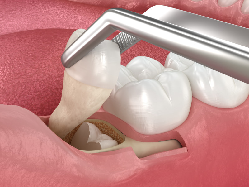 Gentle tooth extractions